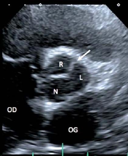 Figure 3 — Parasternale petit axe de la valve aortique, en diastole. La valve est fermée et l'on voit la ligne de fermeture : un trait rectiligne, qui traverse la racine sans passer par son centre et sans dessiner le Y à trois branches d'une valve tricuspide. Elle sépare une grande cuspide conjointe, formée des sigmoïdes droite (R) et gauche (L), de la sigmoïde non coronaire (N). La flèche désigne le raphé, entre R et L — et c'est déjà tout le piège de la section 4.4 : sur une valve fermée, ce trait est indiscernable d'une commissure. Image évocatrice, jamais suffisante : il faut ouvrir la valve.