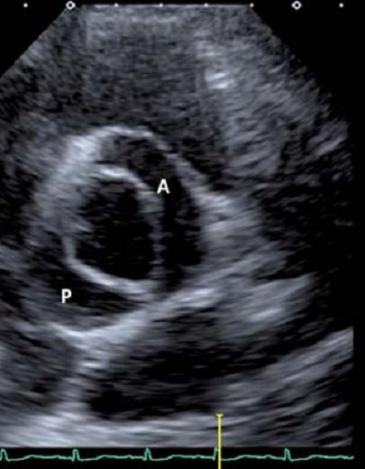Figure 4 — Même coupe, en systole : c'est cette image qui fait le diagnostic. L'ouverture de la valve aortique (A) est ovalaire, en fente allongée — l'aspect dit en bouche de poisson — et ne comporte que deux commissures fonctionnelles, diamétralement opposées, au lieu du triangle à trois pointes d'une valve normale.