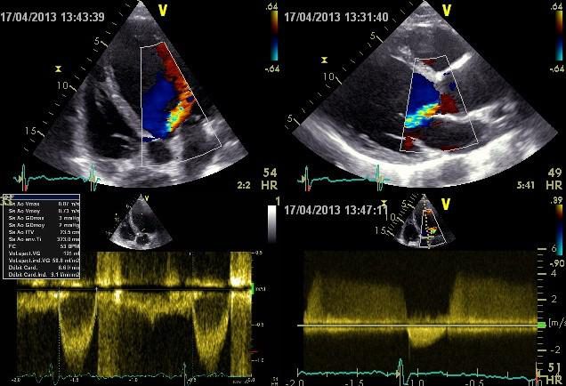 Figure 6 — La fuite, et ce qu'elle n'empêche pas de mesurer. En haut, apicale et parasternale grand axe : un jet régurgitant aortique aliasé, en mosaïque, naît de la valve aortique et pénètre dans la chambre de chasse du ventricule gauche. En bas à droite, le Doppler continu apical le confirme — enveloppe dense et holodiastolique, culminant vers 4 m/s au-dessus de la ligne de base, à décroissance lente, alors que le signal systolique d'éjection reste petit sous la ligne de base : c'est la signature de l'insuffisance aortique. Le flux antérograde, lui, est normal : le tableau de mesures donne une Vmax de 0,87 m/s, un gradient maximal de 3 mmHg et un gradient moyen de 2 mmHg. La valve fuit, elle ne sténose pas — cas de figure typique de la bicuspidie du sujet jeune, et exactement le patient qu'il faut inscrire dans un suivi à vie.