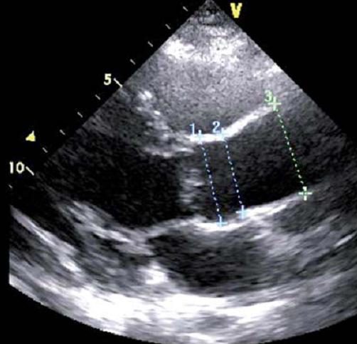 Figure 7 — La mesure qui compte autant que la valve. Parasternale grand axe centrée sur la racine aortique : trois calipers seulement sont posés ici — anneau aortique (1), sinus de Valsalva (2), aorte ascendante tubulaire (3). Le quatrième niveau manque sur cette acquisition : la jonction sinotubulaire est le rétrécissement situé entre les repères 2 et 3, et elle doit être mesurée elle aussi — c'est son effacement qui définit le phénotype racine. Mesurez toujours aux mêmes niveaux, perpendiculairement au grand axe du vaisseau, et indexez le résultat à la surface corporelle.