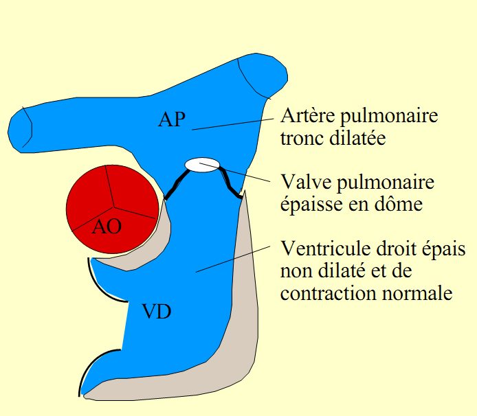 Figure 2 — Sténose valvulaire pulmonaire typique : la valve épaissie s'ouvre en dôme, le tronc de l'artère pulmonaire est dilaté en aval par la lésion de jet, et le ventricule droit est épais mais ni dilaté ni hypokinétique.