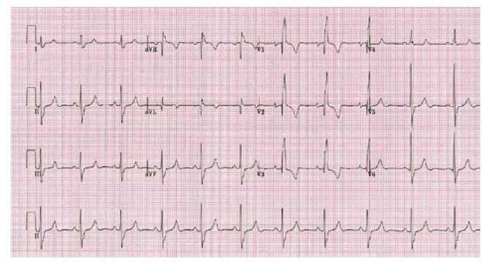 Figure 3 — Hypertrophie ventriculaire droite sur l'électrocardiogramme d'un obstacle du cœur droit : onde R dominante en V1 (rapport R/S supérieur à 1) et ondes S persistantes en V5-V6. Deux réserves à connaître sur ce tracé : les ondes R sont ici également amples en précordiales gauches, ce qui donne un aspect de surcharge biventriculaire plutôt que d'hypertrophie droite pure ; et l'onde T reste négative en V1-V3, ce qui n'exclut nullement l'hypertrophie droite — une onde T positive en V1 au-delà de la première semaine de vie est un argument de plus, non un critère obligatoire.