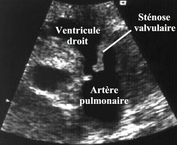 Figure 5 — Repères anatomiques de la voie d'éjection droite en échographie, sur une image légendée par l'auteur : le ventricule droit en amont, la valve pulmonaire épaissie et sténosée au niveau indiqué par le trait de rappel, l'artère pulmonaire en aval. La reproduction est bruitée : elle sert de repère de localisation, et non de démonstration du bombement en dôme ni de la dilatation post-sténotique, qui ne sont pas lisibles ici.