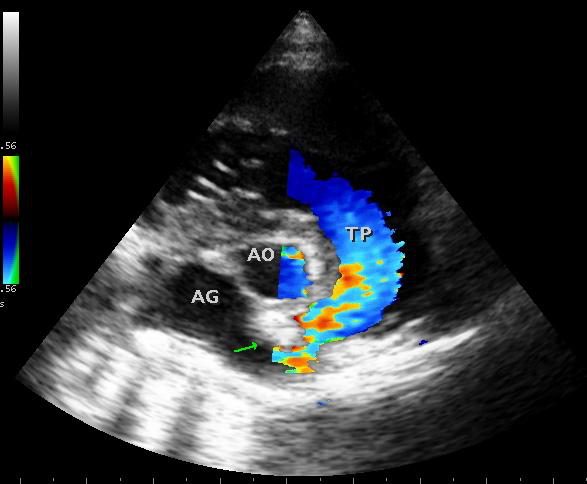 Figure 6 — Doppler couleur en petit axe des gros vaisseaux : le flux bleu du tronc pulmonaire (TP) se brise en mosaïque avec aliasing dès le franchissement de la valve. C'est ce point de naissance de la turbulence qui localise l'obstacle. AO : aorte en section. Les étiquettes portées sur l'image sont celles de la diapositive d'origine ; la structure marquée AG correspond au massif auriculaire gauche.