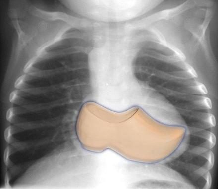 Figure 5 — Le même cliché, avec la silhouette d'un sabot dessinée par-dessus l'ombre cardiaque. Cette surimpression ne sert qu'à fixer l'analogie : la pointe relevée forme le talon, l'arc moyen creusé forme le cou-de-pied. Elle ne sert pas à l'exercice de lecture — l'annotation recouvre ici ce qu'elle désigne. C'est sur la figure précédente, et sur elle seule, que se lisent les trois signes.