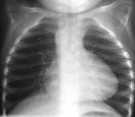 Figure 4 — Radiographie de thorax de face d'un nourrisson porteur d'une tétralogie de Fallot : le cliché brut. Cherchez-y vous-même, avant de regarder la figure suivante, les trois éléments du cœur en sabot : un volume cardiaque normal — il n'y a pas de cardiomégalie —, une pointe relevée au-dessus de la coupole diaphragmatique par l'hypertrophie du ventricule droit, et un arc moyen gauche creusé, concave, parce que le tronc de l'artère pulmonaire est hypoplasique et ne fait plus saillie. Regardez enfin les champs pulmonaires : ils sont clairs, la vascularisation est diminuée.