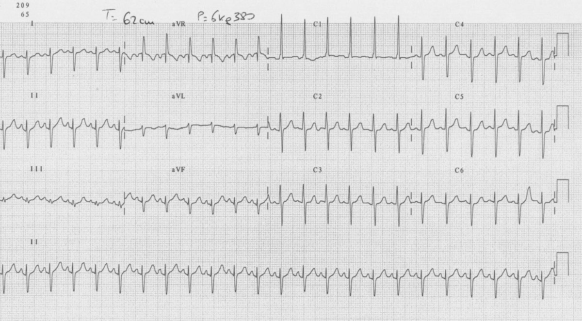 Figure 6 — Électrocardiogramme d'un nourrisson porteur d'une tétralogie de Fallot. Ce tracé porte son argument dans les précordiales : grande onde R monophasique en V1 (C1), transition tardive, onde S profonde en V6 (C6) — c'est l'hypertrophie ventriculaire droite, conséquence directe du travail à pression systémique. Dans les dérivations des membres, notez l'onde S profonde en D1 ; mais aVR y est positif et D2 négatif, ce qui n'est pas la déviation axiale droite classique et impose de vérifier le placement des électrodes des membres avant toute conclusion sur l'axe. La déviation axiale droite se définit, elle, par un QRS négatif en D1 ET positif en aVF (section 5.2).
