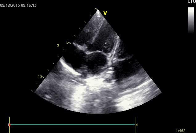 Figure 10 — Bifurcation du tronc de l'artère pulmonaire en ses deux branches, droite et gauche : la structure en Y, à parois échogènes, occupe la partie haute du secteur. L'image n'est ni annotée ni mesurée, et c'est justement l'exercice — reconnaître la bifurcation, puis placer les curseurs sur chaque branche, à son origine et perpendiculairement à son axe. C'est ce calibre, rapporté à l'aorte descendante (indice de McGoon) ou à la surface corporelle (indice de Nakata), qui dit si le lit pulmonaire pourra accepter la totalité du débit une fois la communication interventriculaire fermée.