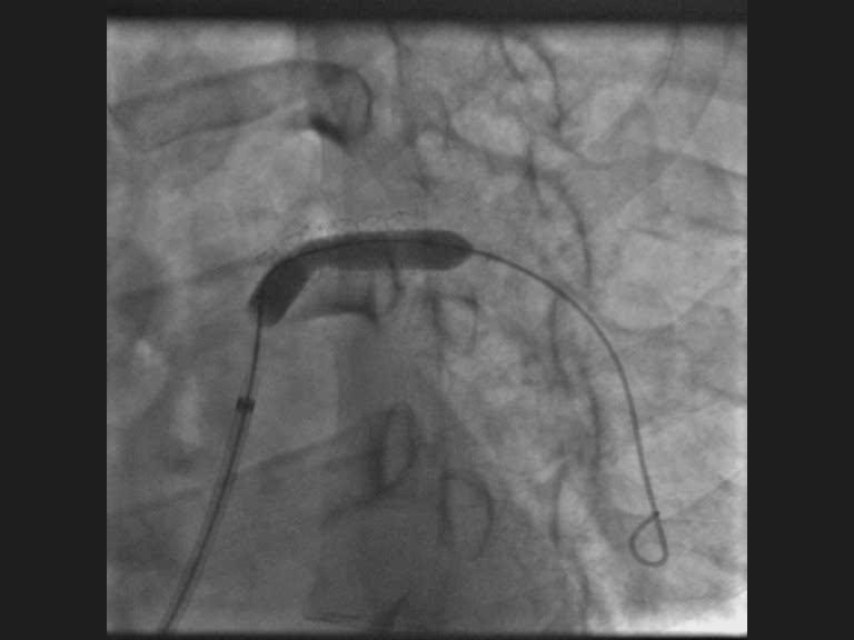 Figure 10 — Dilatation percutanée au ballon d'une sténose résiduelle de la voie pulmonaire, cliché de scopie de face. Le ballon, gonflé de produit de contraste, est ici complètement expansé : l'empreinte centrale — la « taille » — visible au début du gonflage au niveau de la zone rétrécie a disparu, ce qui signe la levée de l'obstacle. Le cathéter porteur monte depuis la voie veineuse fémorale et une sonde en boucle occupe les cavités droites. Attention à ne pas surinterpréter ce type de cliché : AUCUNE endoprothèse n'est en place ici — on ne voit qu'un ballon à bord lisse, sans maille métallique ni marqueur de stent. La disparition de l'empreinte signe l'expansion du ballon et la levée de l'obstacle, jamais le déploiement d'une valve. Et rappelez-vous le prix de ce geste sur une valve remaniée : dilater lève l'obstacle, mais crée ou aggrave une fuite.