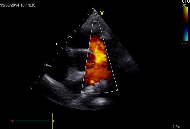 Figure 2 — Fuite pulmonaire au Doppler couleur, coupe parasternale petit axe centrée sur la voie d'éjection droite et le tronc pulmonaire. Repérez la large colonne de flux en mosaïque orange-jaune qui occupe toute la largeur de la voie pulmonaire : la couleur chaude signe un flux dirigé VERS la sonde, donc revenant de l'artère pulmonaire vers le ventricule droit — c'est bien un reflux, et il est aussi large que l'anneau, aspect typique après patch transannulaire. Une réserve honnête : cette vignette ne comporte pas de tracé électrocardiographique, si bien que le caractère diastolique du flux ne se vérifie pas sur l'arrêt sur image — il se lit sur l'image animée ou au Doppler spectral. Retenez enfin le paradoxe : ce flux massif ne s'accompagne le plus souvent d'aucun souffle audible.