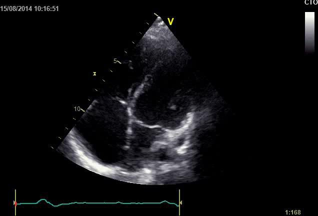 Figure 3 — Dilatation des cavités droites en coupe apicale des quatre cavités chez le même patient. Deux choses seulement sont réellement lisibles dans cette incidence, et ce sont les bonnes : les cavités droites, à gauche de l'écran, sont nettement élargies, et le ventricule droit vient occuper la pointe du cœur, qui revient normalement au seul ventricule gauche. L'image est sombre et les contours endocardiques peu nets : n'y cherchez pas de mesure. N'y cherchez pas non plus l'aplatissement du septum — la courbure septale s'apprécie en parasternal PETIT axe, où un ventricule gauche en D signe la surcharge droite ; en apicale quatre cavités, le septum paraît rectiligne y compris chez le sujet normal. C'est ce que l'échographie sait dire : que le ventricule droit est dilaté. Elle ne sait pas dire de combien — d'où le recours à l'imagerie par résonance magnétique.