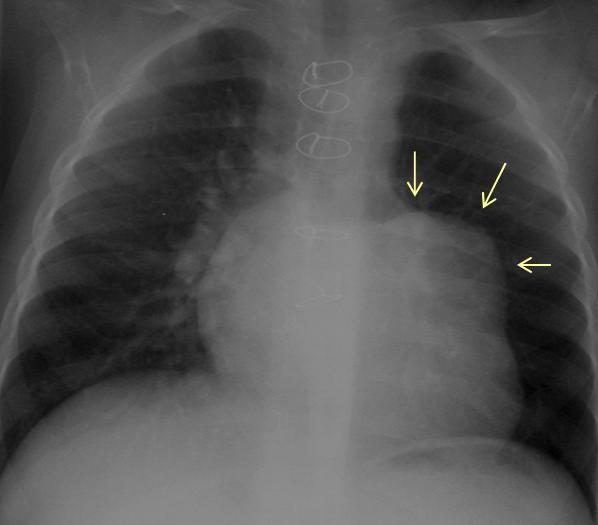 Figure 4 — Radiographie thoracique de face chez un opéré de tétralogie de Fallot. Repérez d'abord les fils de cerclage sternaux sur la ligne médiane, qui signent la sternotomie. Les flèches désignent la saillie de l'arc moyen gauche, témoin de la dilatation du tronc de l'artère pulmonaire, et l'élargissement de l'arc inférieur gauche. L'intérêt de ce cliché est surtout comparatif : c'est l'augmentation du volume cardiaque d'une année sur l'autre, chez un patient qui déclare aller bien, qui doit alerter.