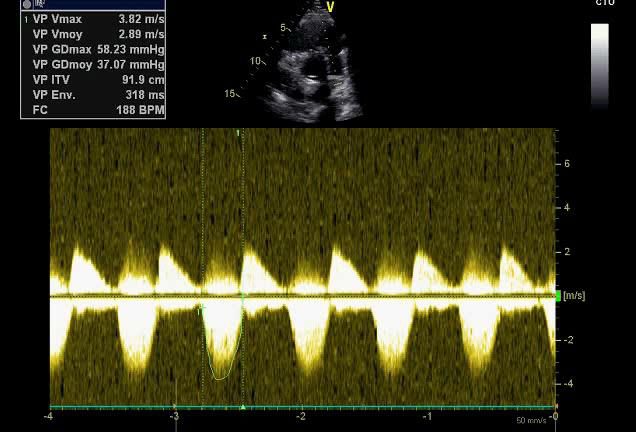 Figure 5 — Obstacle résiduel de la voie pulmonaire quantifié au Doppler continu. Lisez ce tracé dans les deux sens, car il est BIDIRECTIONNEL. Sous la ligne de base, les enveloppes systoliques antérogrades, celles que mesurent les curseurs : vitesse maximale 3,82 m/s, soit un gradient maximal de 58 mmHg et un gradient moyen de 37 mmHg. Au-dessus de la ligne de base, des enveloppes diastoliques triangulaires à décroissance rapide culminant vers 2 m/s : c'est la fuite pulmonaire du même patient. Sténose et fuite coexistent et se majorent l'une l'autre — cette image est l'illustration exacte du va-et-vient décrit en section 8.2. Quant au chiffre de 58 mmHg, il dépasse le seuil de 50 mmHg de référence, plus permissif que celui de l'ESC 2020 (pression systolique ventriculaire droite ≥ 80 mmHg) : un tel obstacle ne se lit jamais isolément, il se confronte à la pression ventriculaire droite, à la perfusion des deux poumons et à la fuite pulmonaire qu'il aggrave.
