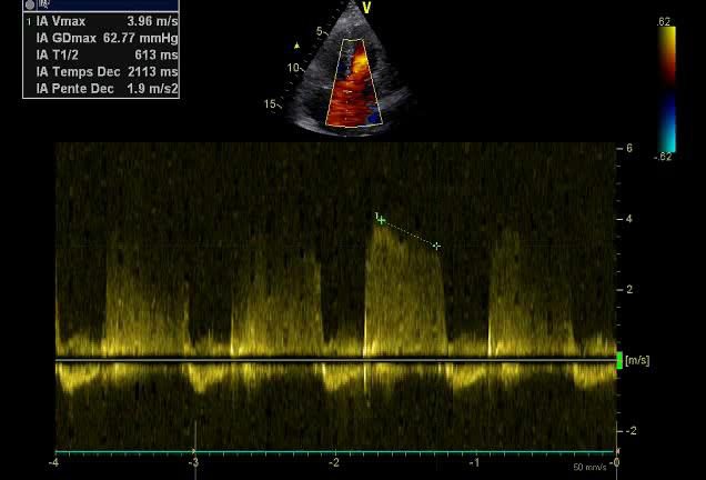 Figure 6 — Insuffisance aortique chez un opéré de tétralogie de Fallot, Doppler continu avec vignette couleur de repérage. La mesure porte sur l'enveloppe POSITIVE, au-dessus de la ligne de base : la fuite est enregistrée en direction de la sonde, tandis que les enveloppes systoliques d'éjection occupent le versant négatif. Vitesse maximale 3,96 m/s, pente de décroissance 1,9 m/s² et surtout temps de demi-décroissance de 613 ms, très supérieur à 500 ms : cette régurgitation est MINIME. Retenez le sens de la relation — plus la fuite aortique est sévère, plus les pressions aortique et ventriculaire gauche s'égalisent vite, donc plus le temps de demi-décroissance est COURT, en dessous de 200 ms ; la fourchette 200-500 ms correspond au grade modéré. C'est la même logique contre-intuitive que pour la fuite pulmonaire. Et la leçon est ailleurs : chez ces patients la racine aortique continue de se dilater, et cette fuite, même minime, doit être mesurée et suivie à chaque examen.