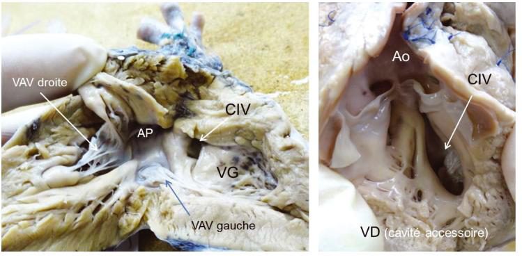 Figure 2 — Ventricule gauche à double entrée, sur pièce anatomique. À gauche, les deux valves auriculo-ventriculaires, la droite et la gauche, s'ouvrent l'une et l'autre dans la même cavité : le ventricule gauche. Repérez l'artère pulmonaire et, sous elle, la communication interventriculaire. À droite, le gros plan montre l'aorte naissant d'une petite cavité accessoire de type droit, alimentée exclusivement par cette communication : c'est le foramen bulbo-ventriculaire, et son calibre conditionne tout le débit systémique.