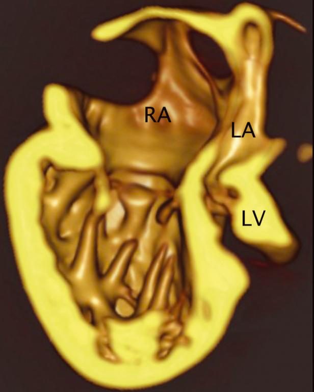 Figure 3 — Scanner en reconstruction volumique, coupe de type quatre cavités : un ventricule dominant et une chambre rudimentaire. À gauche de l'image, une vaste cavité à trabéculations grossières reçoit l'oreillette droite — c'est le ventricule dominant, de morphologie droite. À droite, sous l'oreillette gauche, la cavité ventriculaire se réduit à une fente. Voilà l'image même d'un cœur qui a bien deux ventricules et qui ne pourra jamais être réparé à deux ventricules. Attention aux annotations, qui sont celles de la console et en anglais : RA désigne l'oreillette droite, LA l'oreillette gauche, et LV la petite cavité gauche hypoplasique, à droite de l'image. Le ventricule dominant, la grande cavité de gauche, n'est pas étiqueté — ne reportez pas « LV » sur lui.