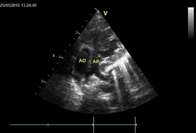 Figure 6 — Échocardiographie, coupe des gros vaisseaux chez un enfant porteur d'un cœur univentriculaire. Les deux annotations jaunes posées par l'échographiste désignent l'aorte et l'artère pulmonaire : les deux troncs sont vus <strong>parallèles et côte à côte</strong>, au lieu de se croiser comme dans un cœur normal — c'est l'aspect d'une malposition des gros vaisseaux. Notez la limite de cette image, car elle est instructive : leur <em>origine ventriculaire</em> n'est pas dans le champ, et c'est pourtant elle qui commande la suite. Elle se cherche sur d'autres incidences — car si l'aorte naît de la chambre accessoire, tout le débit du corps devra franchir le foramen bulbo-ventriculaire.
