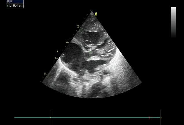 Figure 8 — Mesure d'un orifice interventriculaire étroit en échocardiographie. Les calipers de la machine encadrent un orifice mesuré à quatre millimètres — la mesure de la console, 0,4 cm, est lisible en haut à gauche. L'identification des deux cavités qu'il fait communiquer, cavité principale et chambre accessoire, demande d'autres incidences et n'est pas lisible sur cette seule coupe. Retenez surtout ceci : <strong>ce n'est pas le diamètre brut qui définit la restriction d'un foramen bulbo-ventriculaire</strong>, mais la <strong>surface de l'orifice rapportée à la surface corporelle</strong> — restrictive au-dessous d'environ 2 cm²/m² — et l'apparition d'un <strong>gradient sous-aortique au Doppler</strong>. Quatre millimètres, c'est une surface d'à peine 0,13 cm² : même rapportée à la petite surface corporelle d'un nouveau-né, elle est déjà bien au-dessous du seuil. Et comme l'enfant grandit tandis que l'orifice ne grandit pas, la mesure doit être refaite à chaque contrôle. Si l'aorte naît de la chambre accessoire, ce passage est le seul du débit systémique : c'est un obstacle sous-aortique, qu'un cerclage de l'artère pulmonaire ne ferait qu'aggraver.