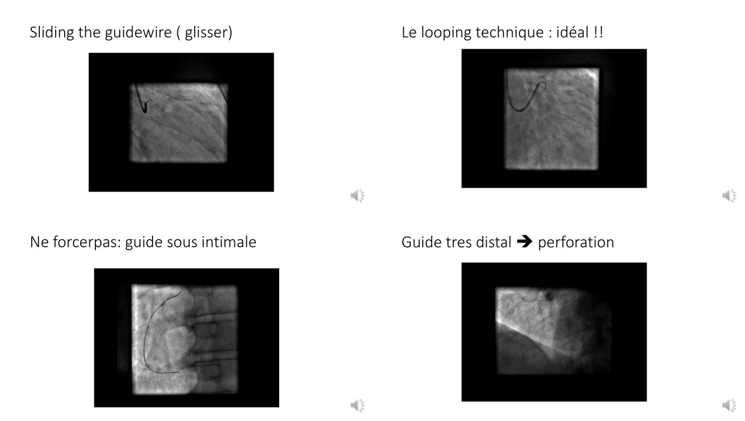 Images de scopie montrant le glissement, la boucle, le trajet sous-intimal et un guide trop distal.
