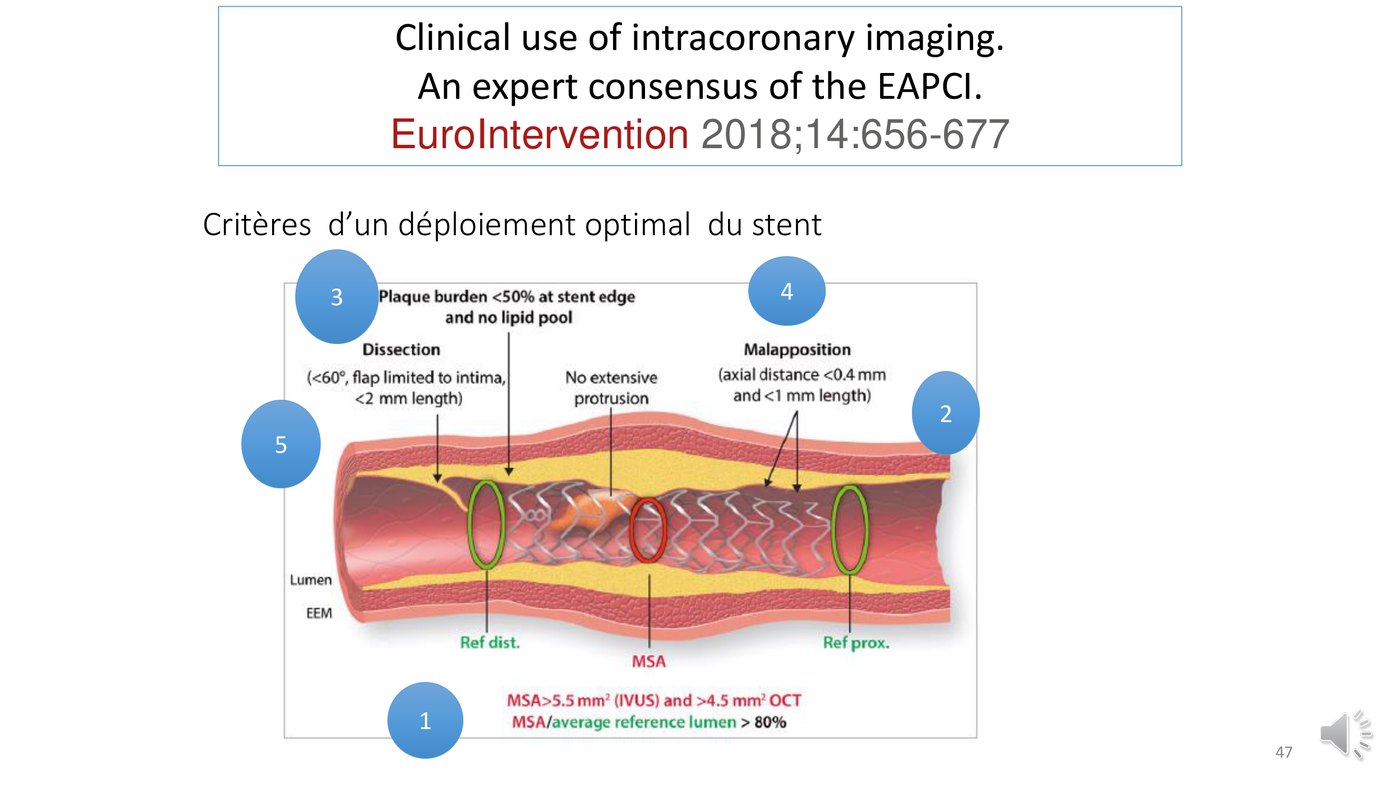 Schéma d'un stent en coupe longitudinale portant les cinq critères EAPCI de déploiement optimal.