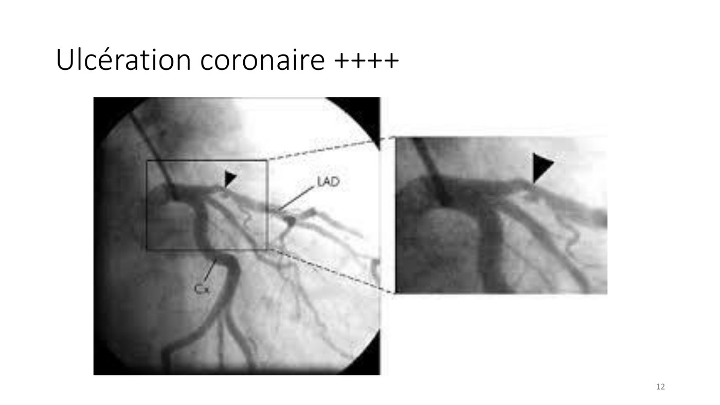 Angiographies coronaires montrant une ulcération de plaque, un flap intimal et un anévrisme.