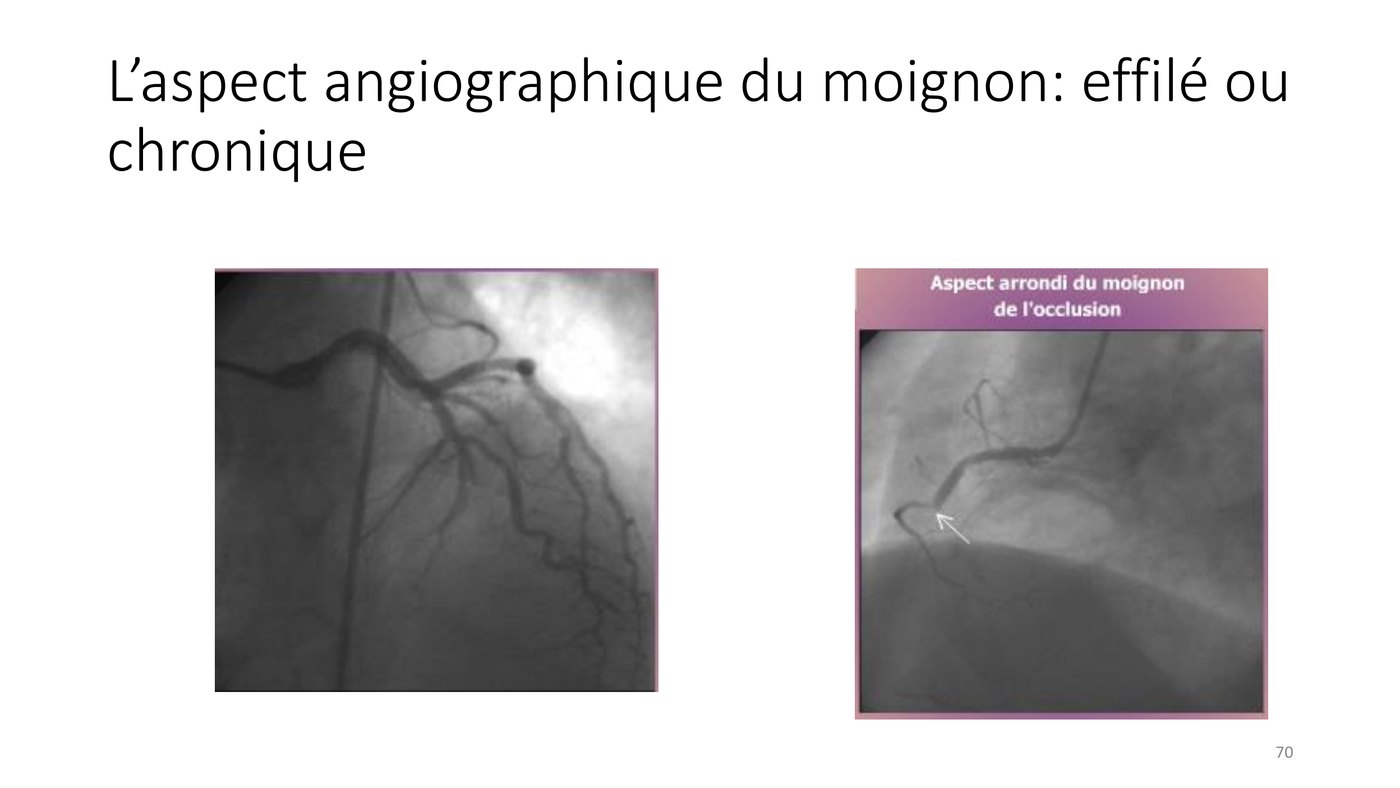 Comparaison angiographique d'un arrêt cupuliforme aigu et d'un moignon effilé d'occlusion chronique.