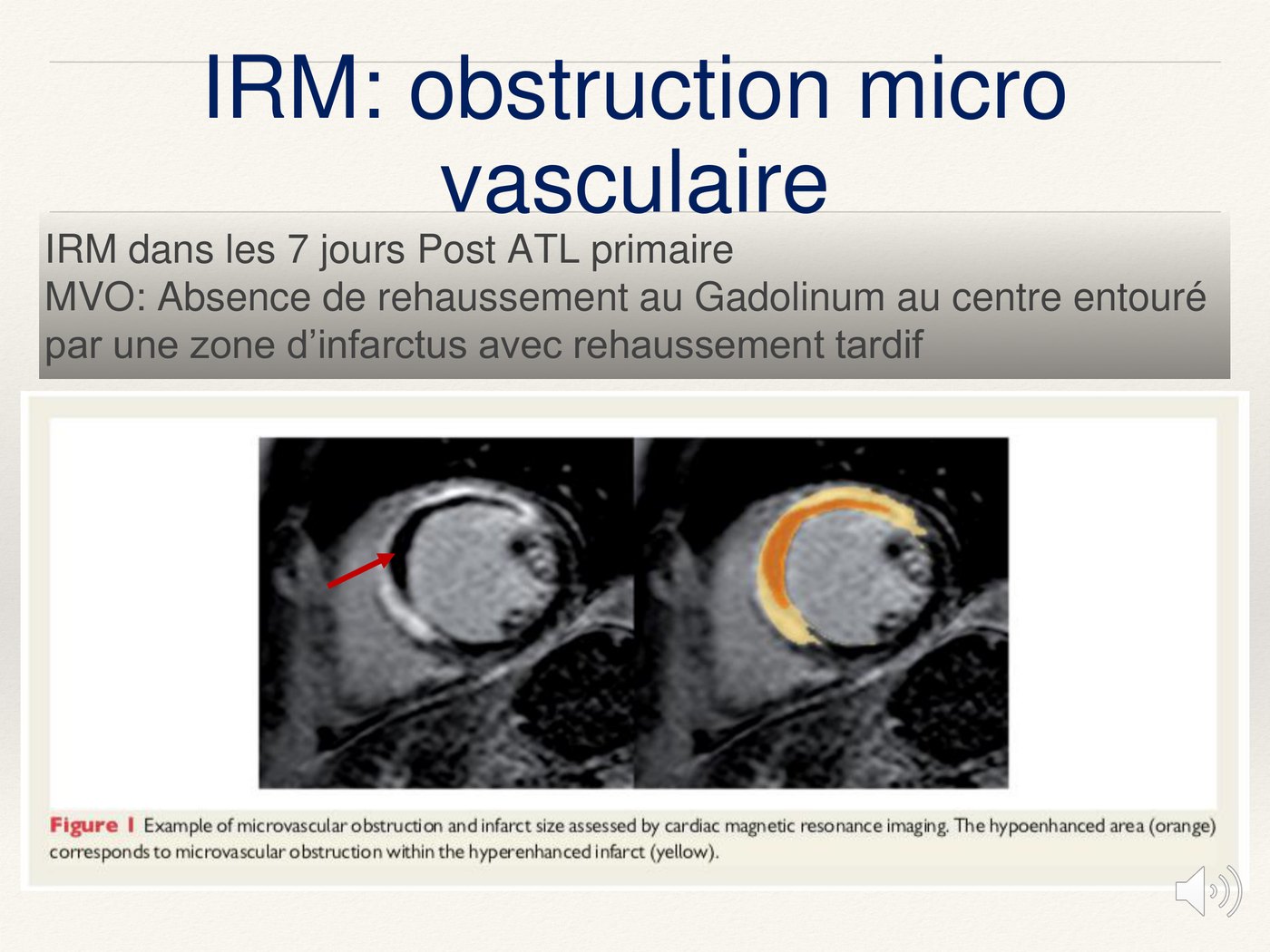 IRM cardiaque en petit axe montrant une zone d'obstruction microvasculaire au centre d'un infarctus rehaussé.