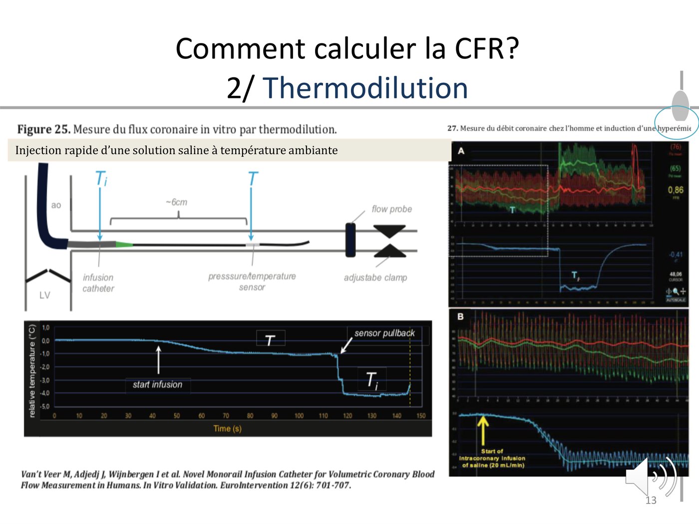 Schéma de la mesure de réserve coronaire par thermodilution coronaire, avec l'injection de sérum salé et l'enregistrement du temps de transit.