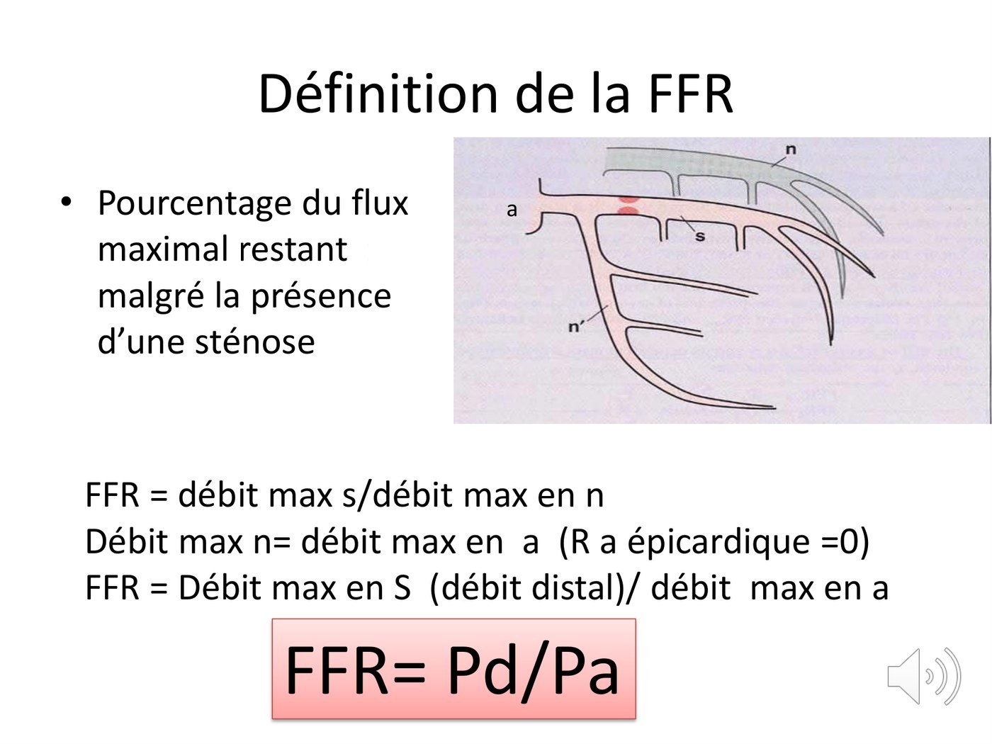 Schéma d'un territoire coronaire sténosé et suite des simplifications menant de la définition de la FFR au rapport de la pression distale sur la pression aortique.