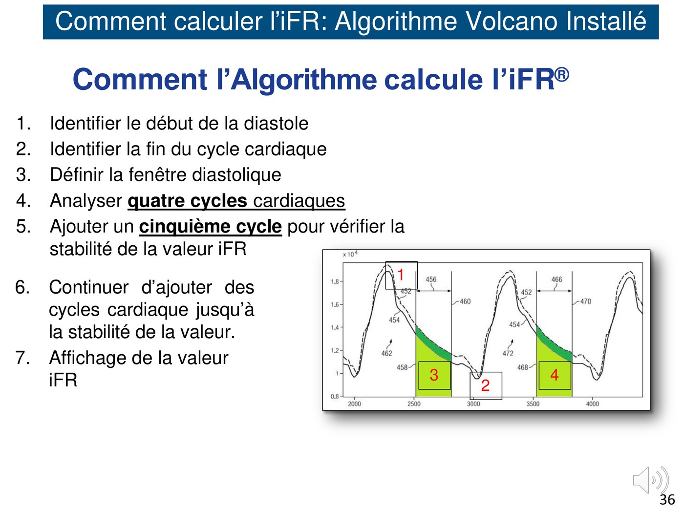 Les sept étapes de calcul automatique de l'iFR et un tracé de pression montrant les fenêtres diastoliques analysées sur des cycles successifs.