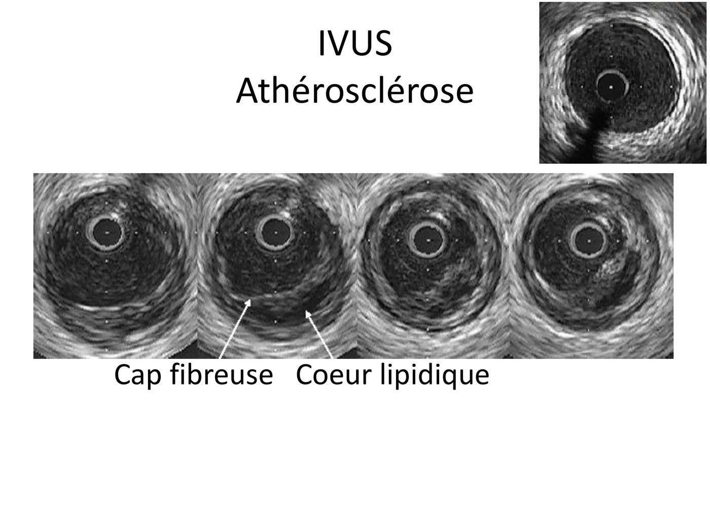 Coupes successives d'échographie endocoronaire montrant une chape fibreuse échogène coiffant un cœur lipidique sombre.