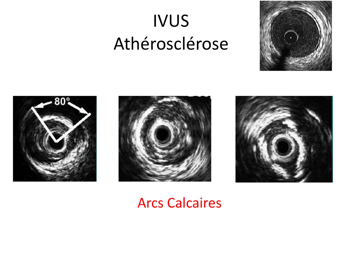 Trois coupes d'échographie endocoronaire montrant des arcs calcaires brillants, la mesure de leur étendue angulaire et les cônes d'ombre qu'ils projettent.