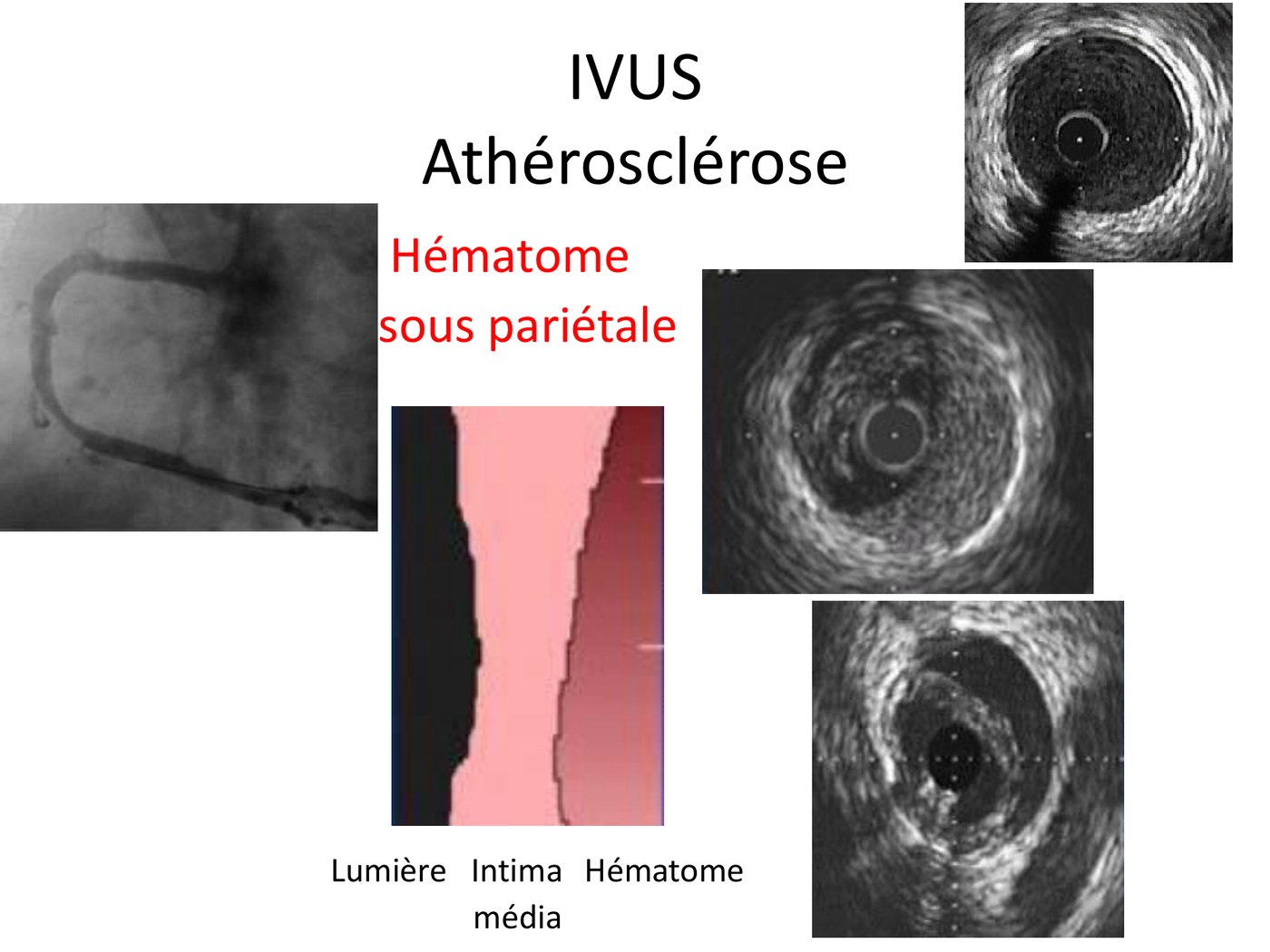 Angiographie, schéma en trois compartiments et coupes d'échographie endocoronaire montrant un hématome sous-pariétal refoulant la lumière.