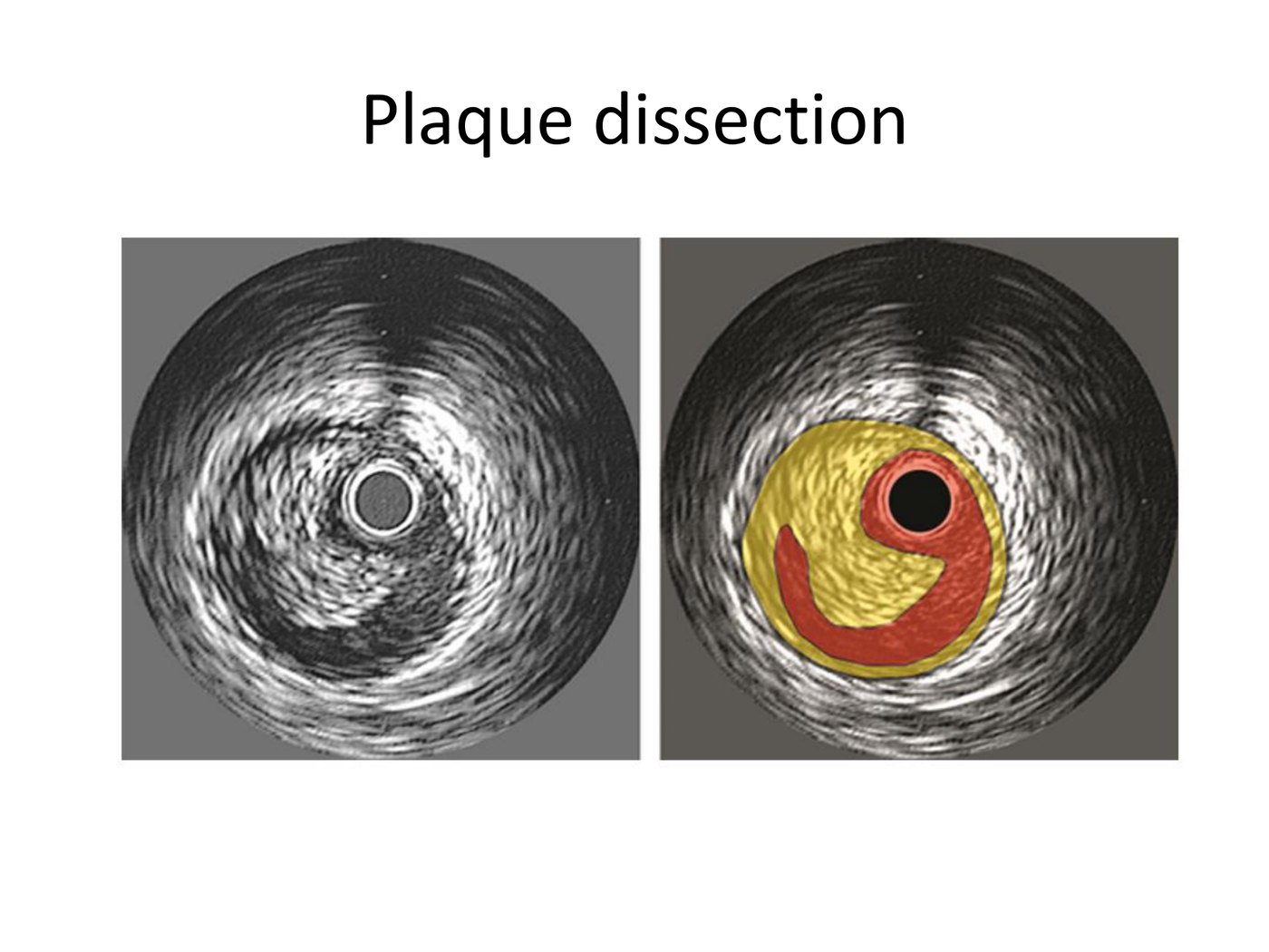 Coupe d'échographie endocoronaire d'une dissection coronaire, présentée brute puis avec la lumière vraie et la paroi colorées.