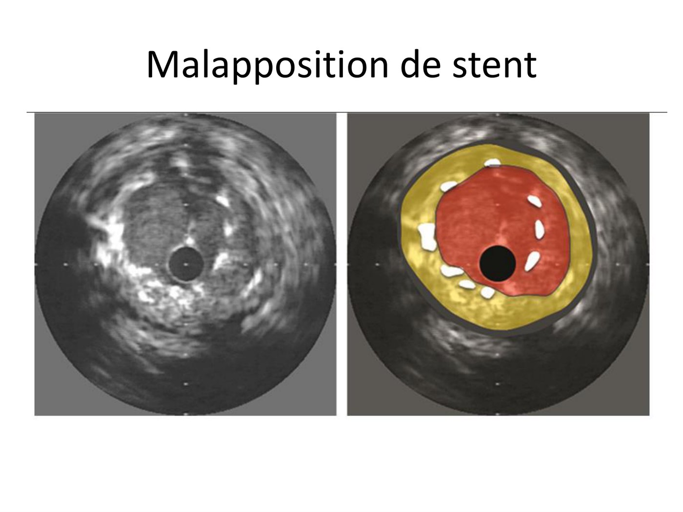 Coupe d'échographie endocoronaire d'un stent dont une partie des mailles est décollée de la paroi, présentée brute puis colorée.