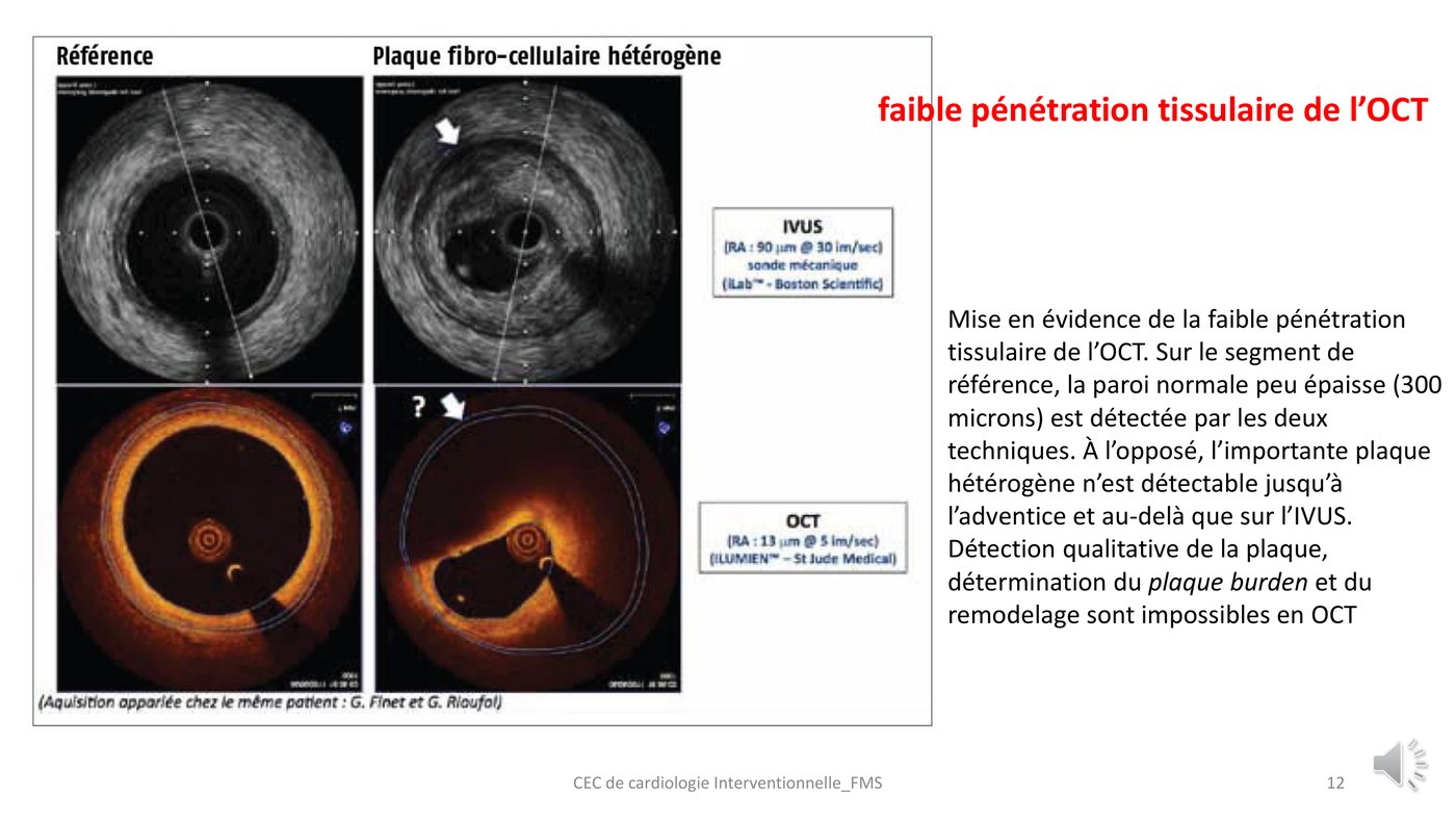 Quatre coupes comparant échographie endocoronaire et tomographie par cohérence optique sur un segment de référence puis sur une plaque épaisse chez le même patient.