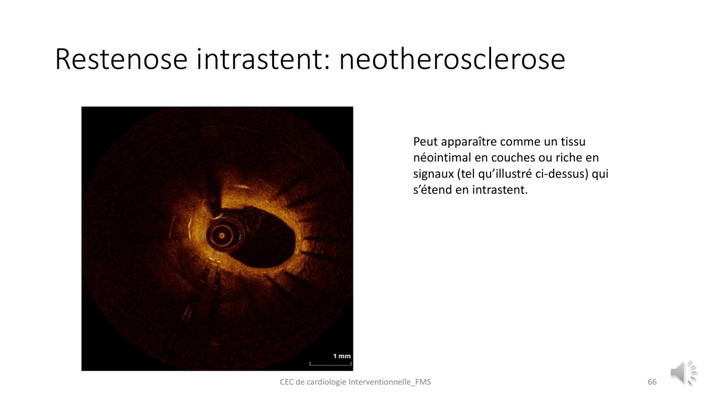Coupe de tomographie par cohérence optique d'une resténose intra-stent tardive par néoathérosclérose, avec un tissu néointimal en couches.