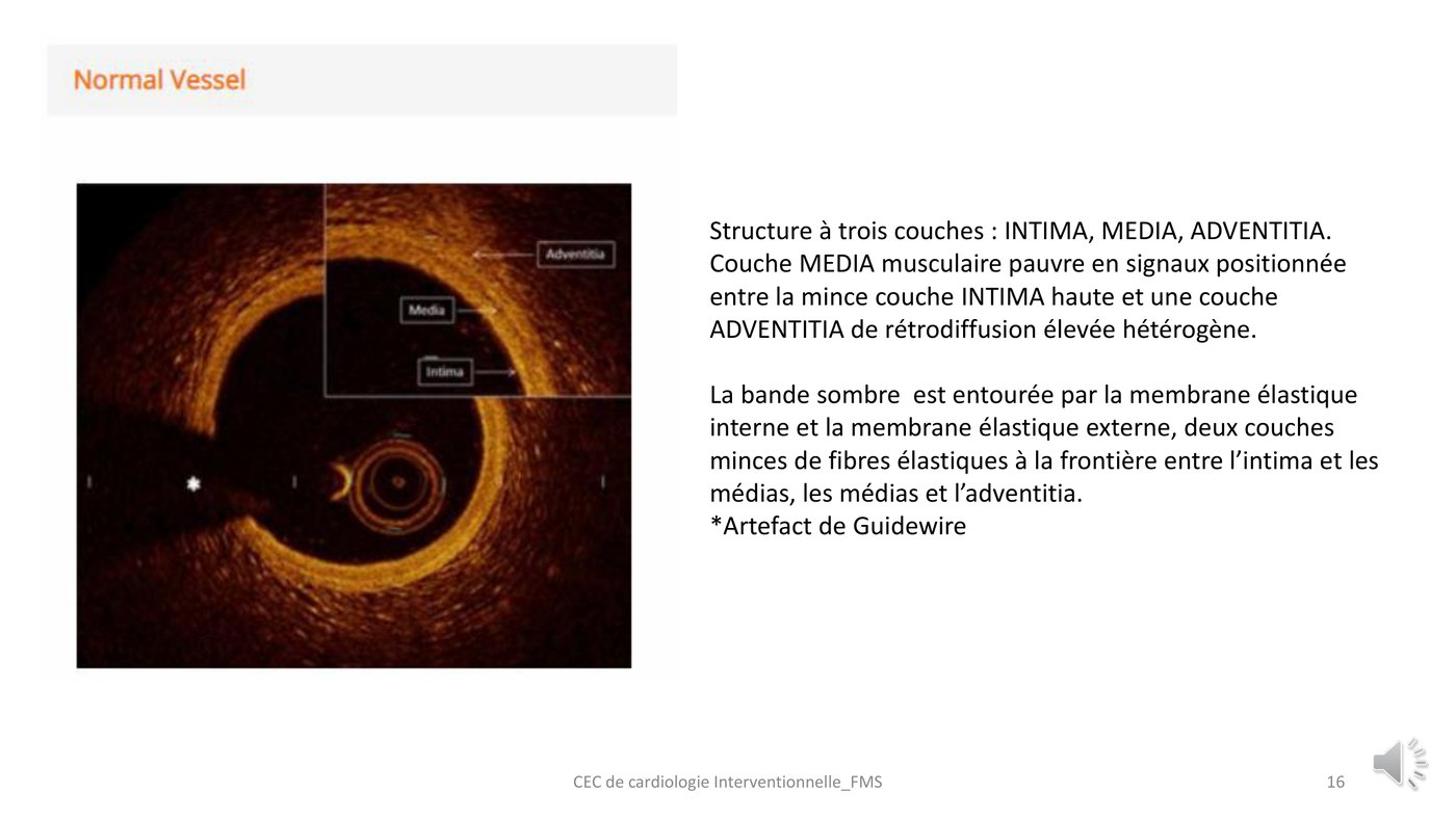 Coupe de tomographie par cohérence optique d'une artère coronaire normale montrant l'intima, la média sombre et l'adventice.