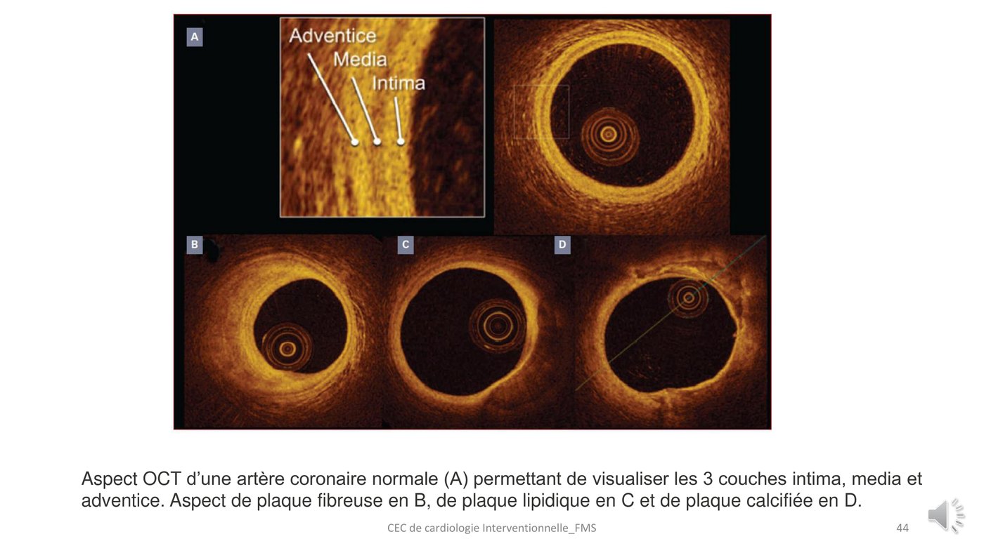Quatre coupes de tomographie par cohérence optique montrant une paroi normale puis une plaque fibreuse, une plaque lipidique et une plaque calcifiée.