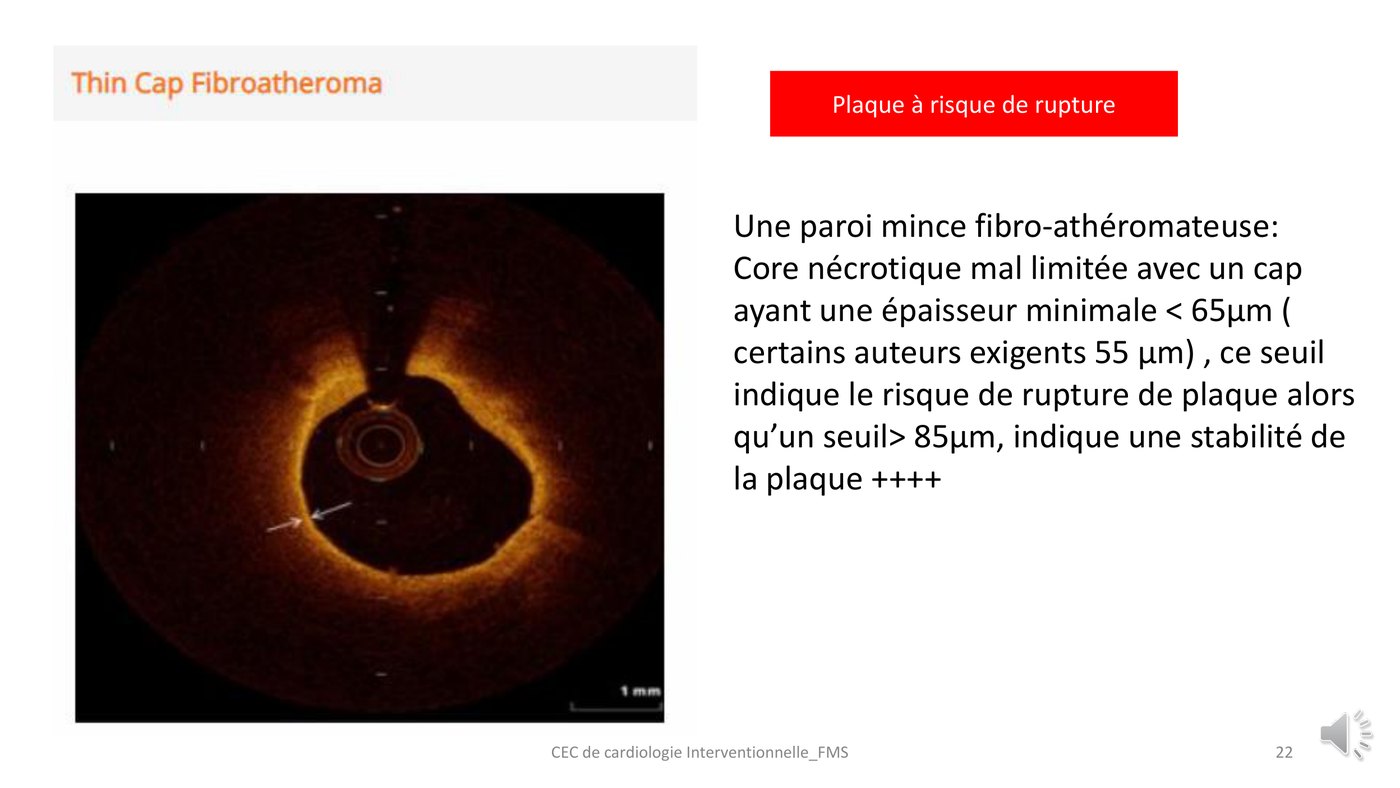 Coupe de tomographie par cohérence optique d'une plaque fibro-athéromateuse à chape mince coiffant un cœur nécrotique.