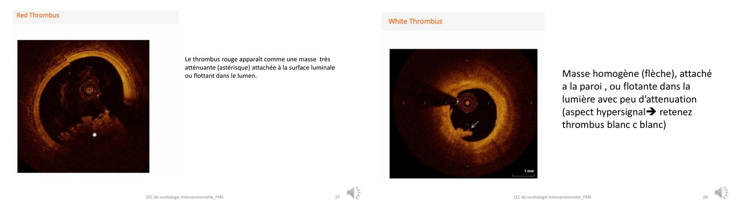 Deux coupes de tomographie par cohérence optique comparant un thrombus rouge très atténuant et un thrombus blanc peu atténuant.