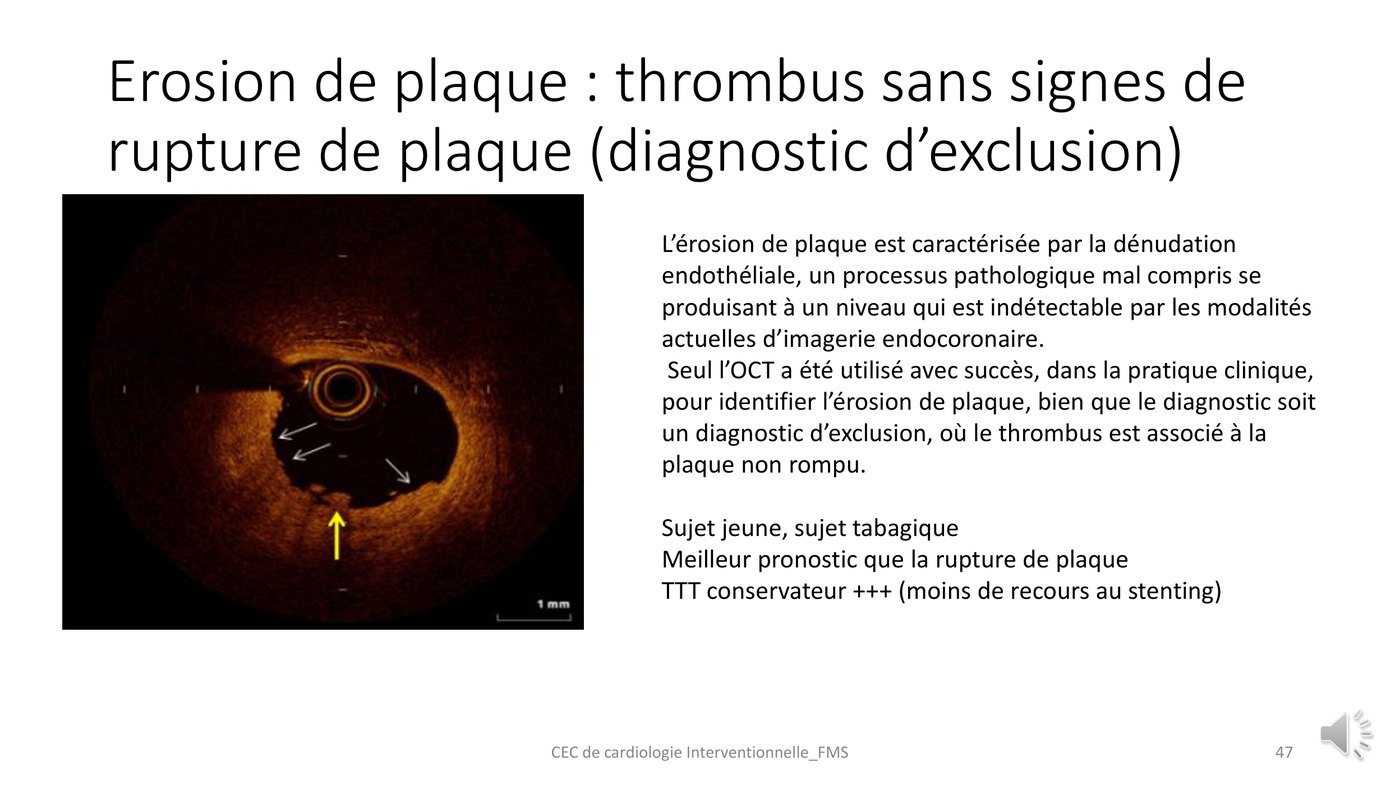 Coupe de tomographie par cohérence optique montrant un thrombus adhérent à une paroi sans rupture de chape, caractéristique d'une érosion de plaque.