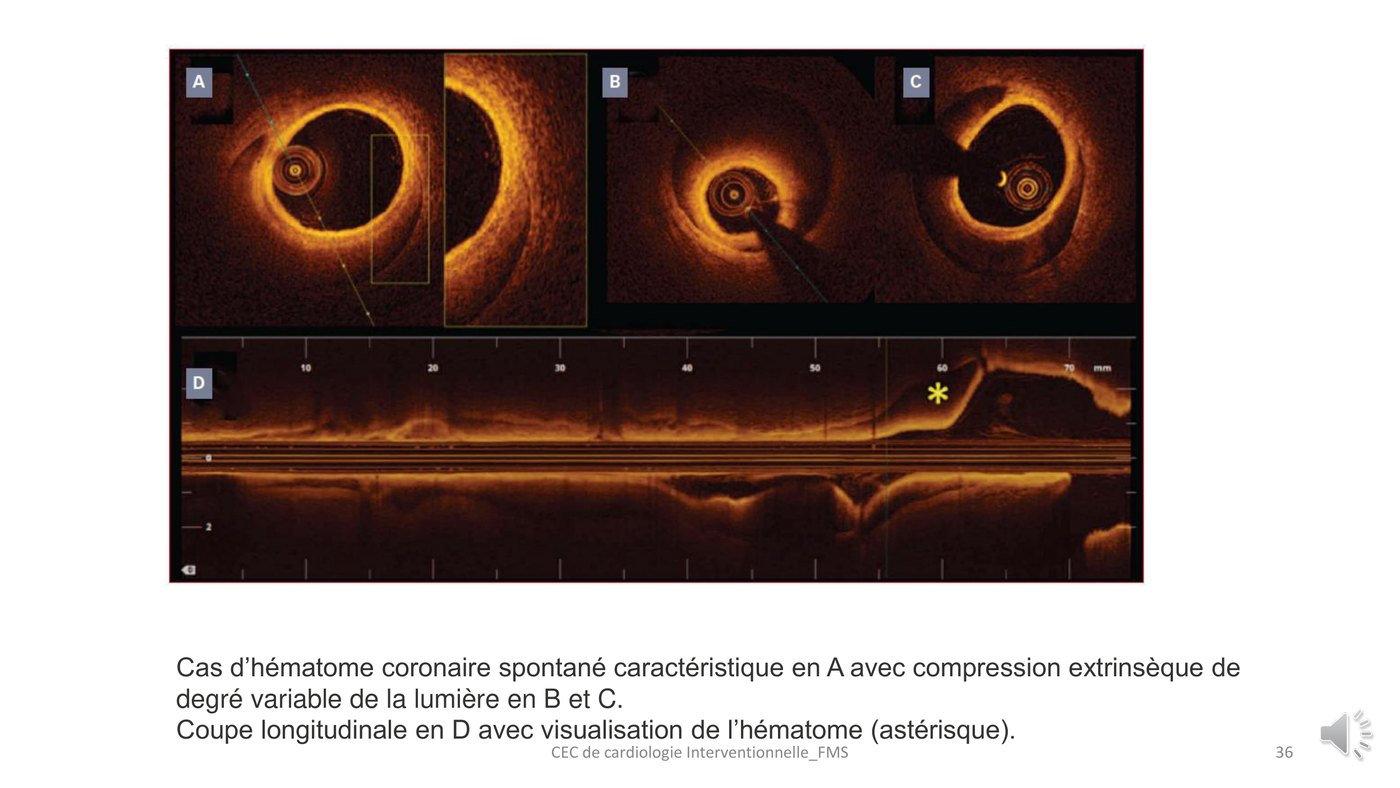 Trois coupes axiales et une vue longitudinale de tomographie par cohérence optique montrant un hématome coronaire spontané comprimant la lumière.