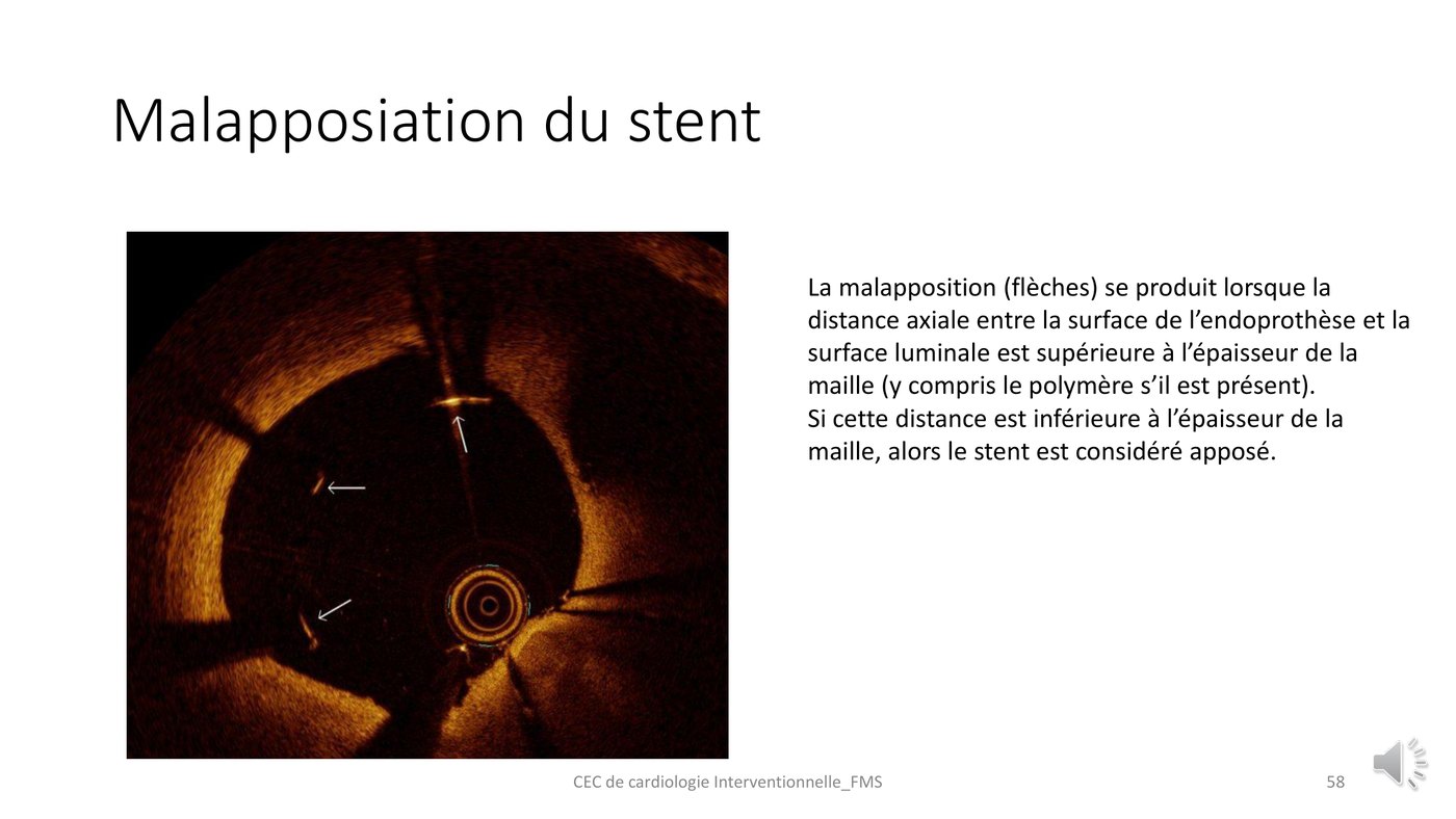 Coupe de tomographie par cohérence optique d'un stent dont plusieurs mailles sont décollées de la paroi.