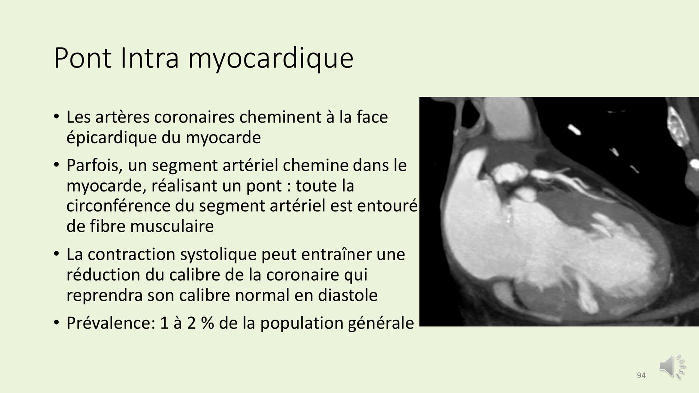 Coupe de scanner cardiaque montrant un segment coronaire cheminant à l'intérieur du myocarde, réalisant un pont intramyocardique.