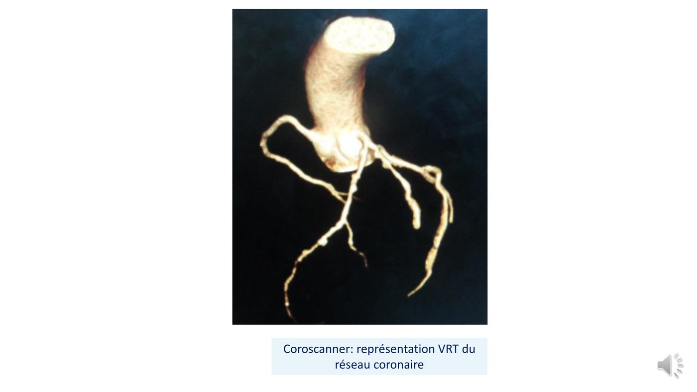Reconstruction tridimensionnelle en rendu de volume du réseau coronaire, les structures osseuses et médiastinales ayant été effacées.