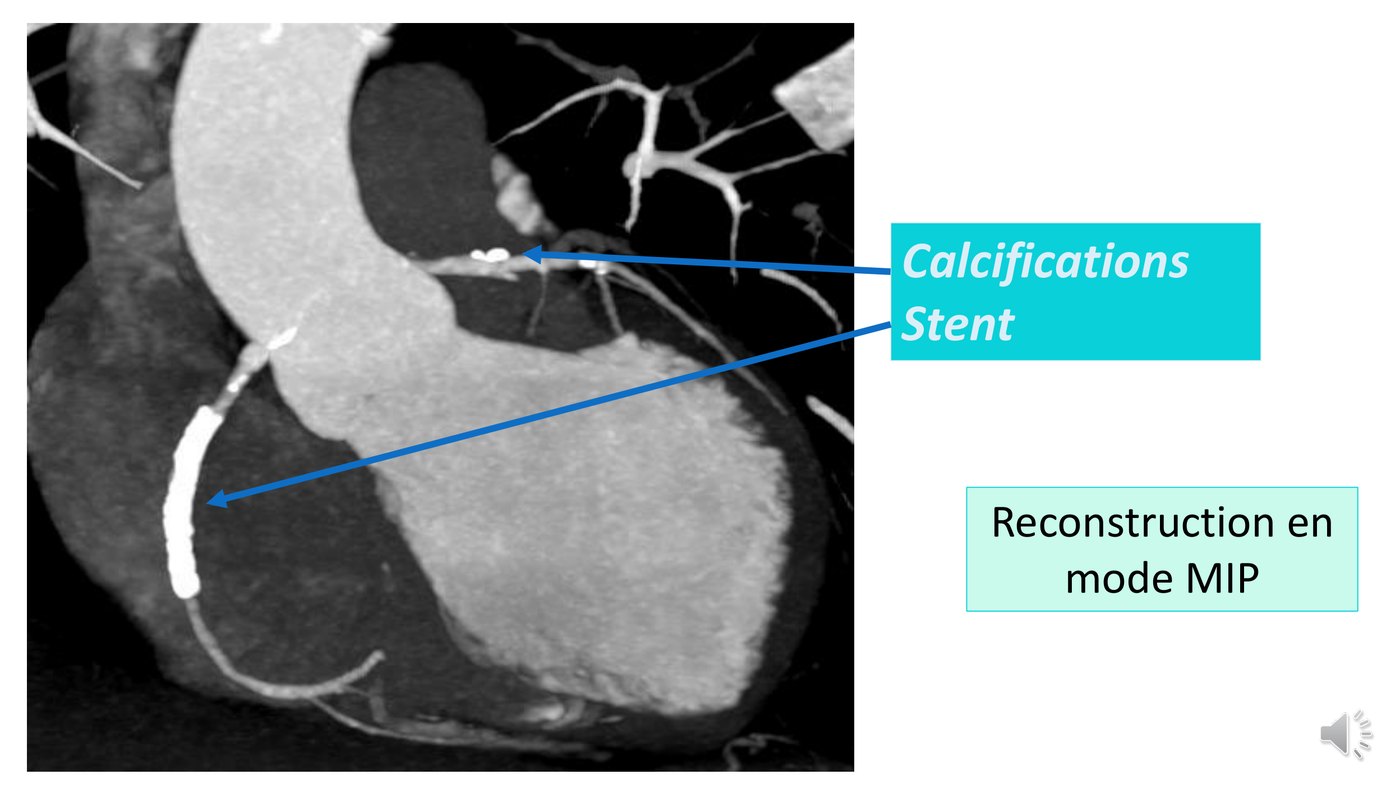 Reconstruction de scanner coronaire en projection d'intensité maximale, montrant des calcifications et un stent.