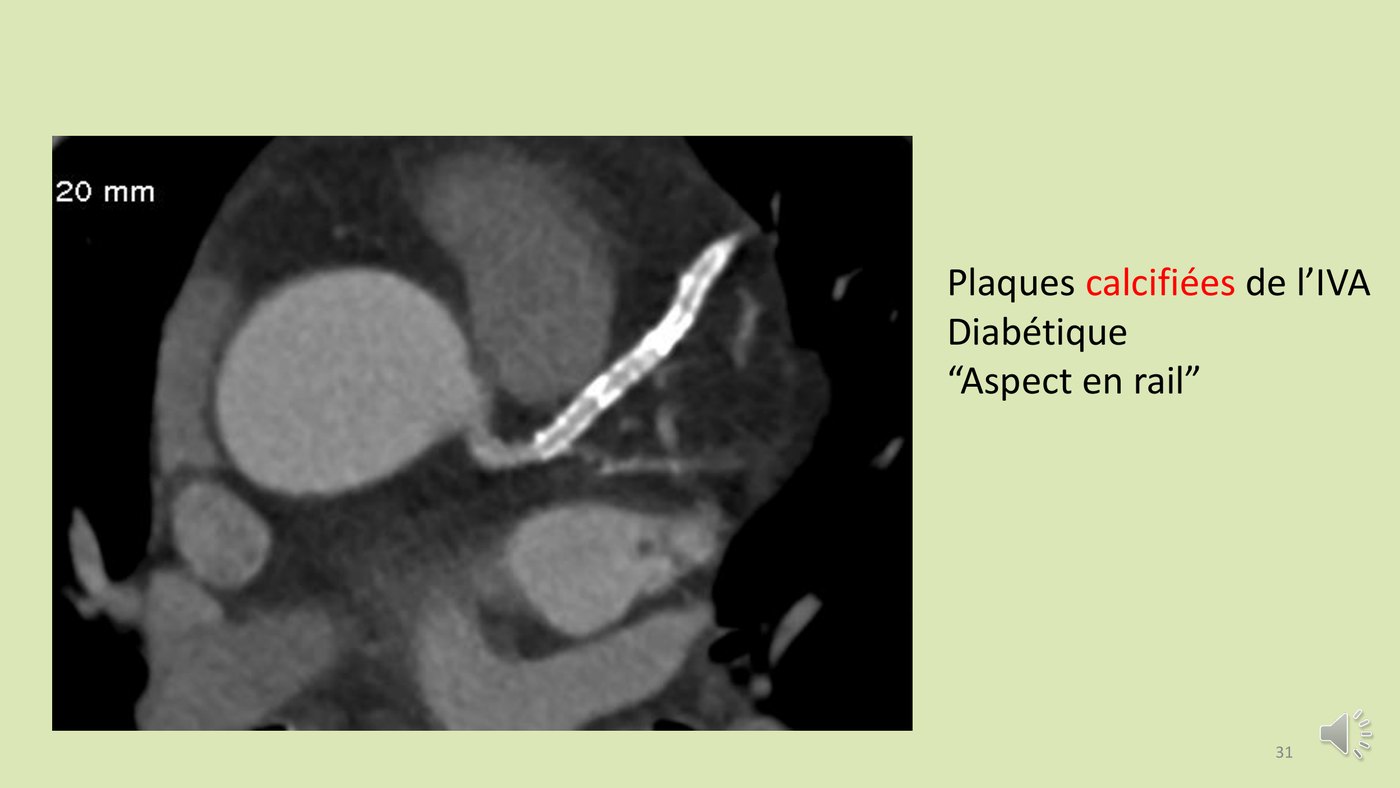 Coupe de scanner coronaire montrant une interventriculaire antérieure bordée de calcifications en rail chez un patient diabétique.