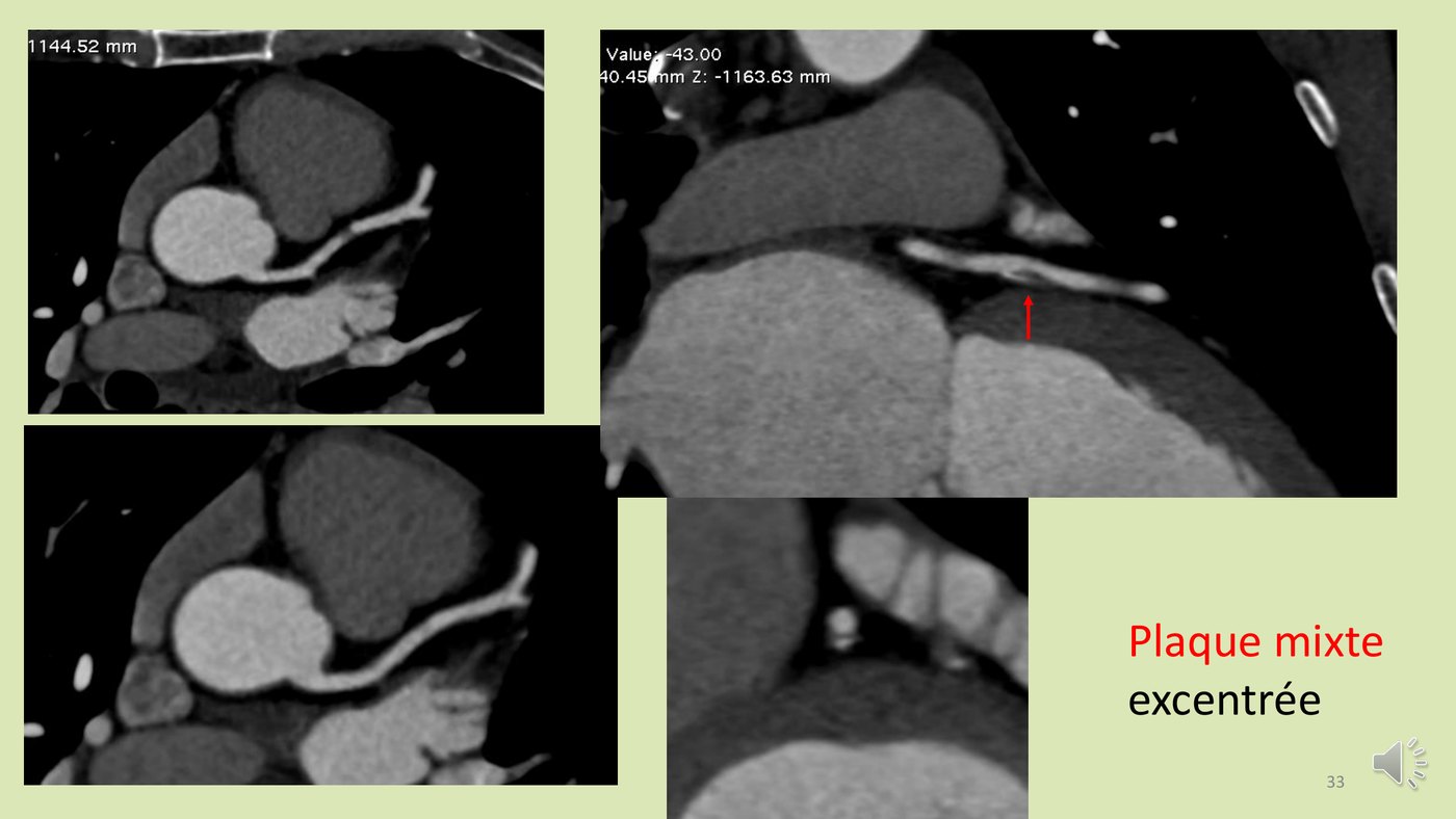 Coupes de scanner coronaire montrant une plaque mixte excentrée associant portions hypodenses et ponctuations calcifiées.