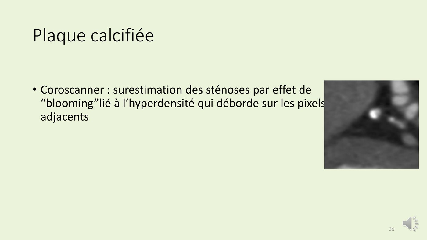Coupe de scanner montrant une calcification coronaire dont l'hyperdensité déborde sur les pixels adjacents.
